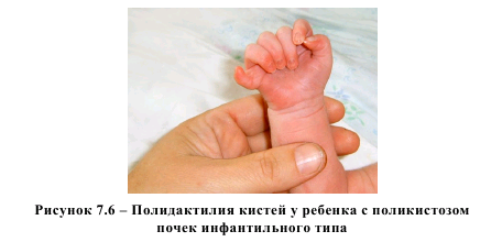 Рисунок 7.6 - Полидактилия китсей у ребенка с поликистозом почек инфантильного типа