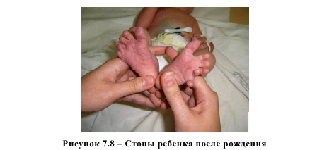 Рисунок 7.8 - Стопы ребенка после рождения, полидактилия стоп