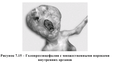 Рисунок 7.15 - Голопроизэицефалия с множнственными пороками внутренних органов