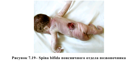 Рисунок 7.19 - Spina bifida поясничного отдела позвоночника