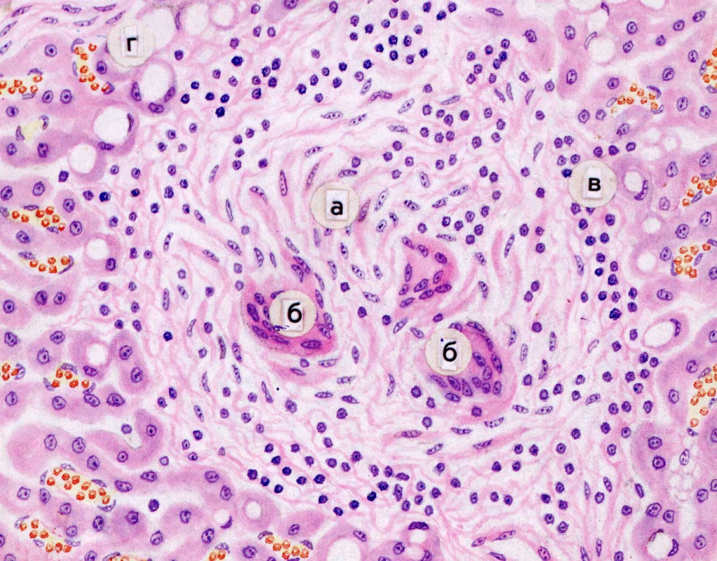 Клетки Пирогова-Лангханса в туберкулезной гранулеме